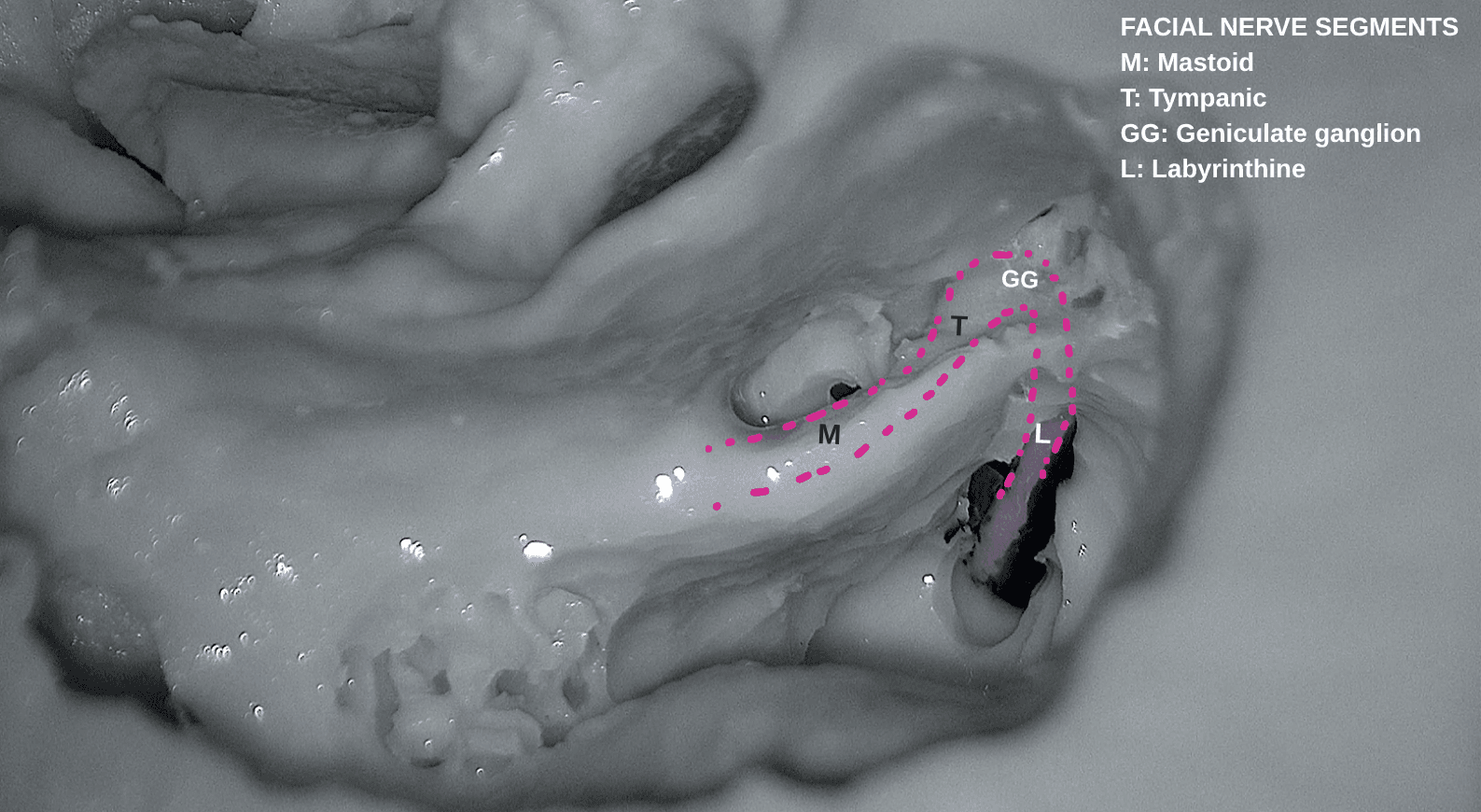 Anatomy plate: segments of the facial nerve