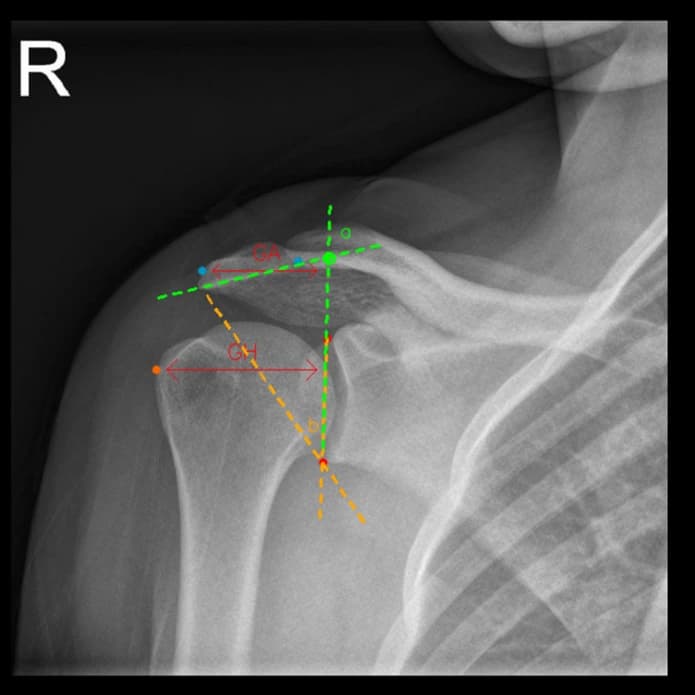 CalculOrther shoulder module output