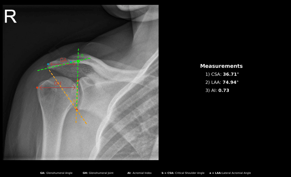 Shoulder module output: CSA 36.71°, LAA 74.94°, AI 0.73