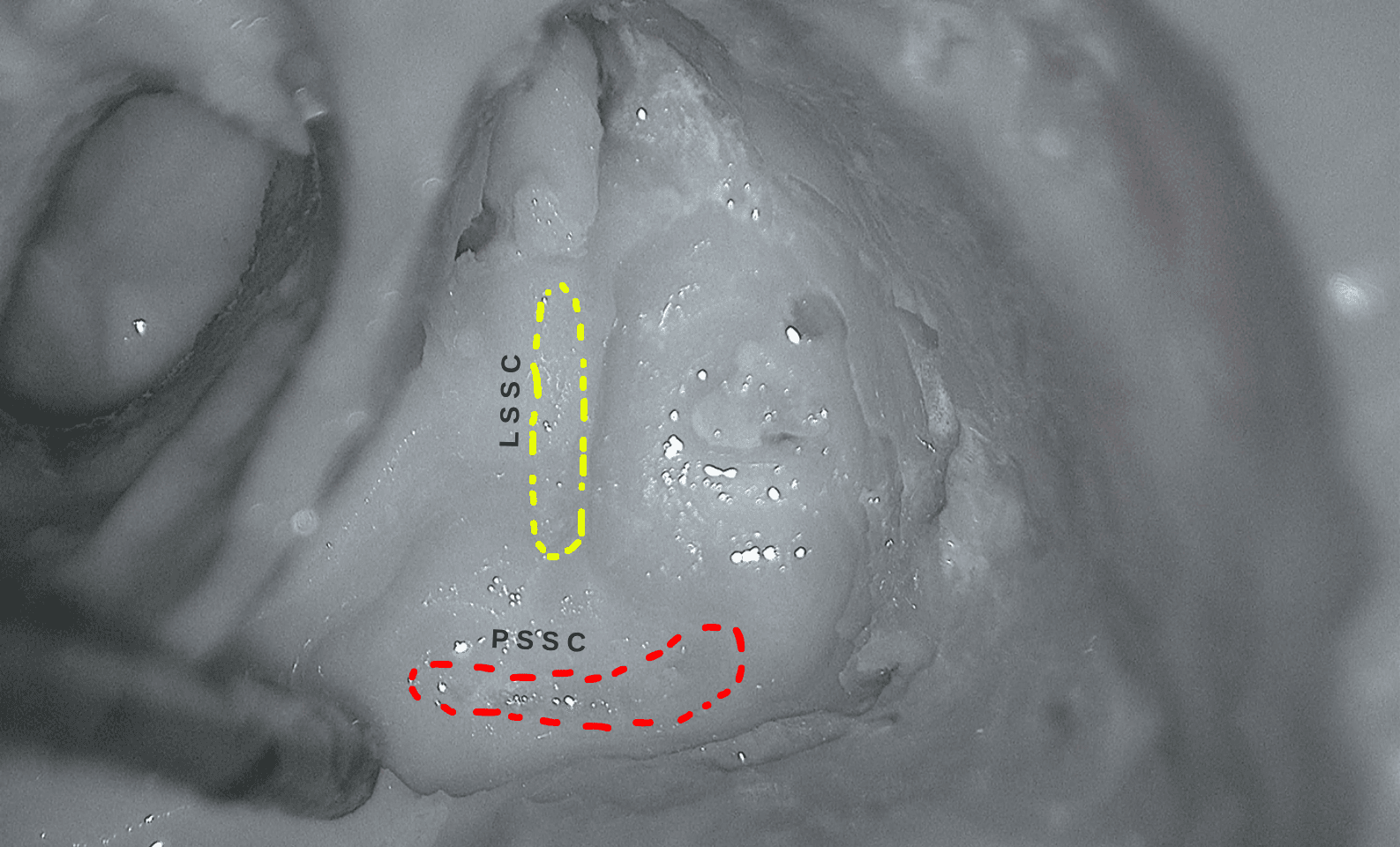 Anatomy plate: the semicircular canals