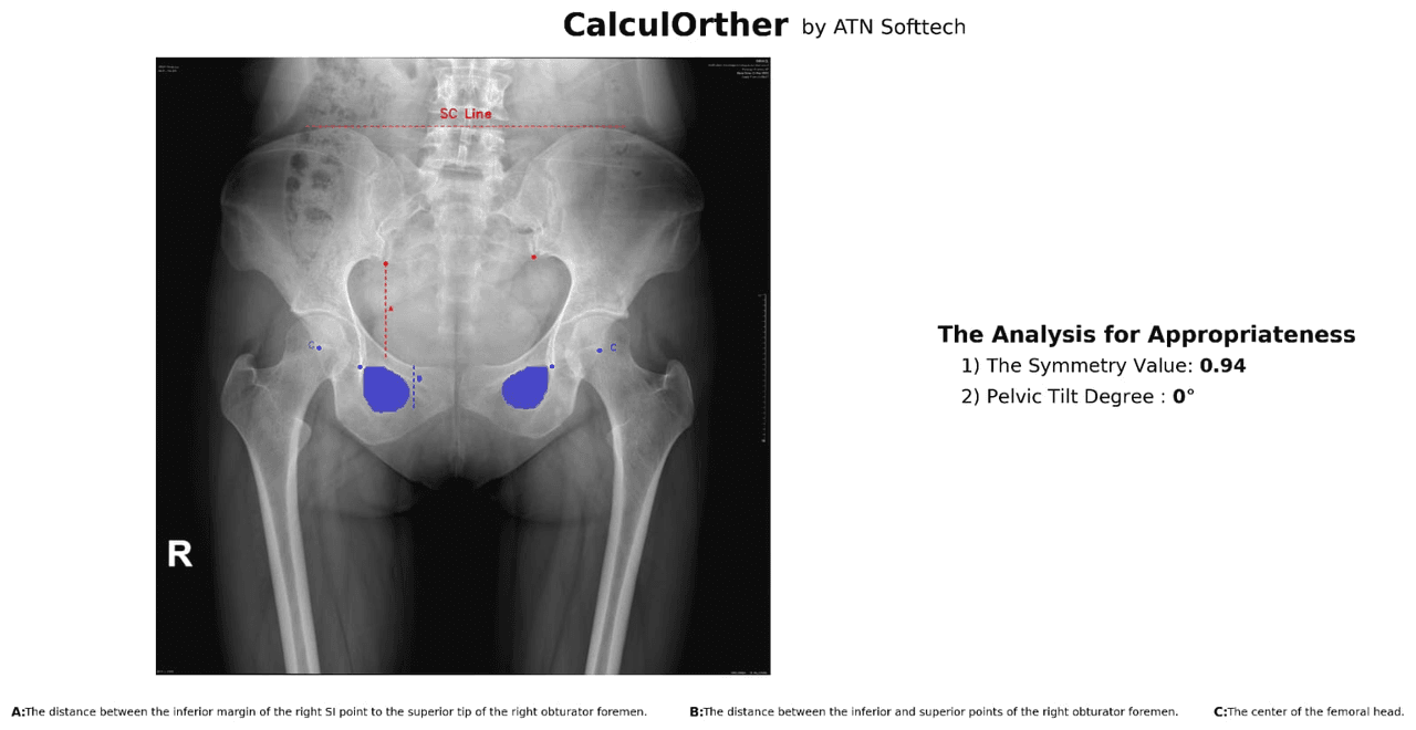 PelSiAn appropriateness analysis output: symmetry 0.94, pelvic tilt 0°