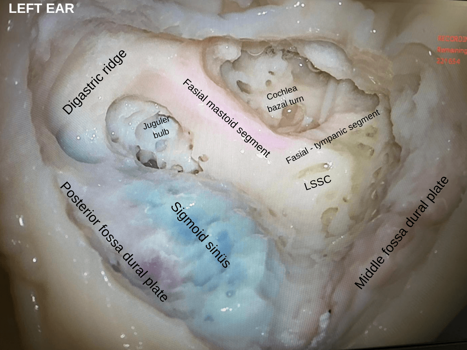 Labeled anatomy plate of the left ear