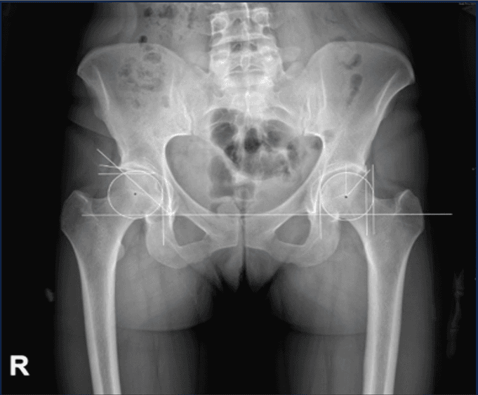 Otomatik bindirmeli pelvis röntgeni