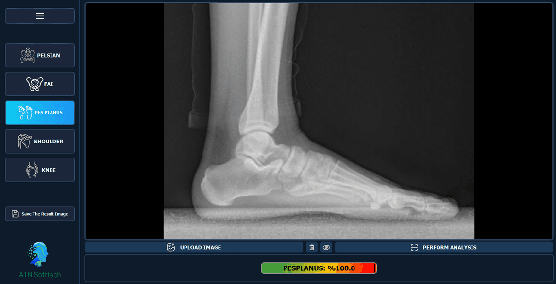CalculOrther application interface, Pes Planus module