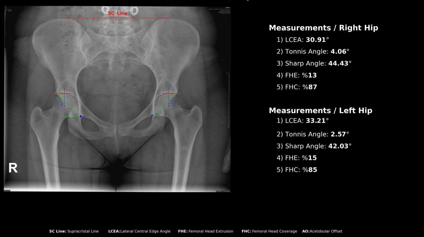 FAI module output measuring both hips