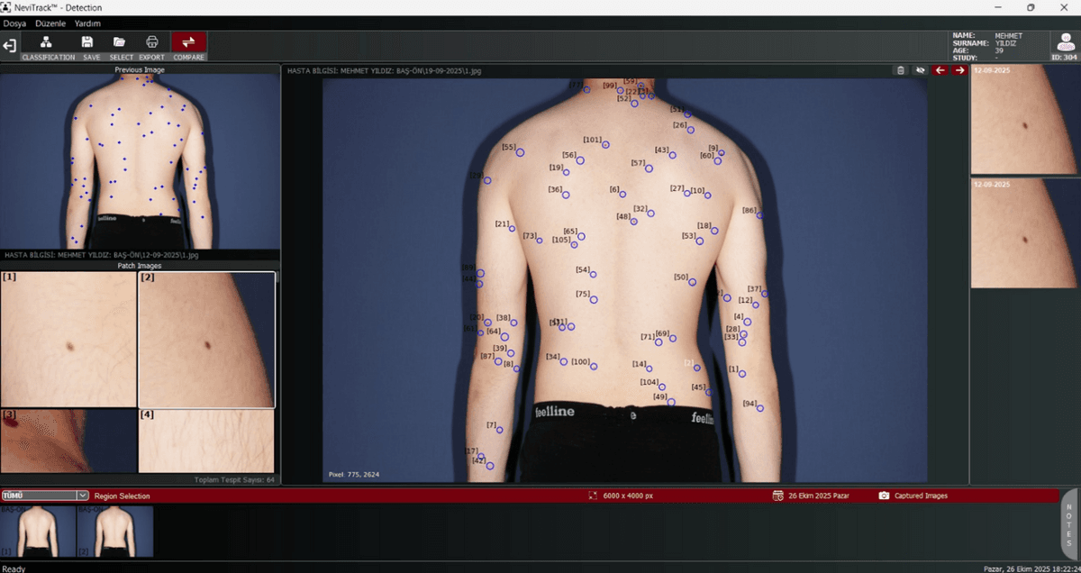 NeviTrack full-body lesion mapping interface